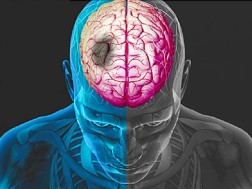 ინსულტი