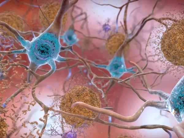 ალცჰაიმერი