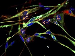 აგრესიული კიბოს უჯრედები მეცნიერებმა ჯანმრთელ უჯრედებად გარდაქმნეს აგრესიული კიბოს უჯრედები მეცნიერებმა ჯანმრთელ უჯრედებად გარდაქმნეს