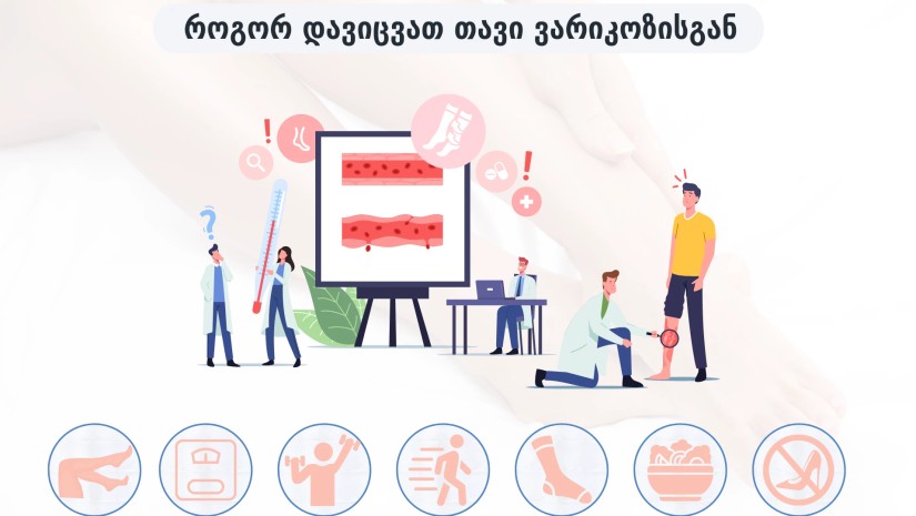 ვარიკოზი ვარიკოზი