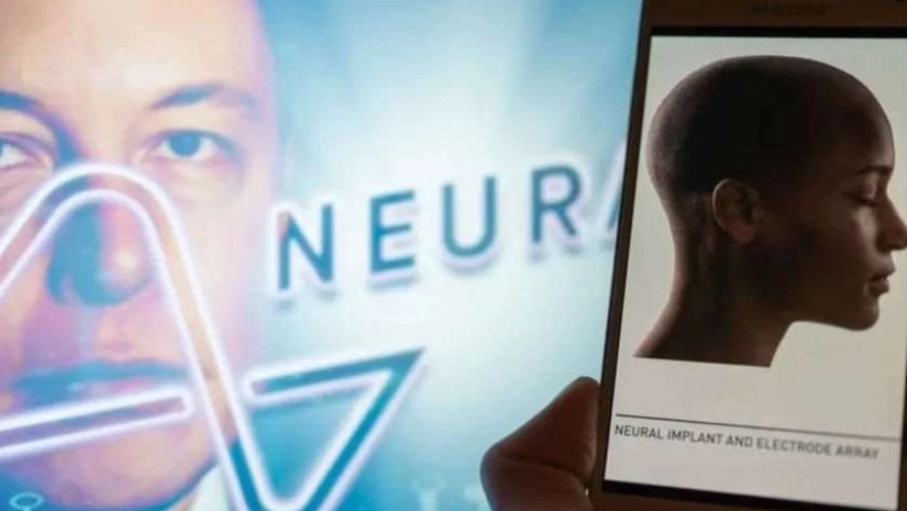 Neuralink-მა ადამიანის ტვინში ჩიპი პირველად ჩანერგა
