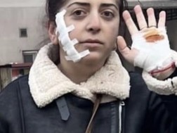 Pikria Epitashvili, whose face was injured with a ruler, is spreading information about her condition