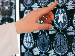 ალცჰაიმერი