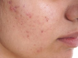 აკნე აკნე