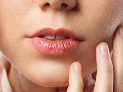 ტუჩების სიმშრალე