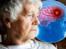 დემენცია