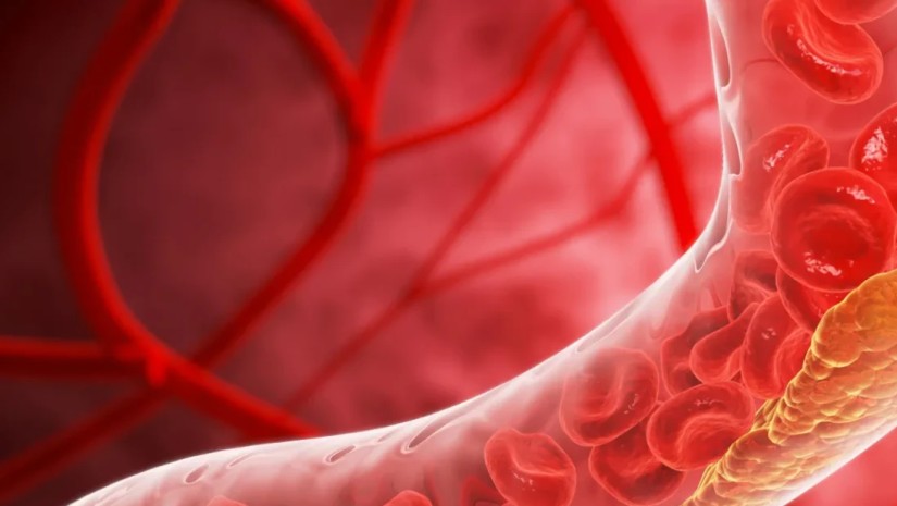 ინსულტი